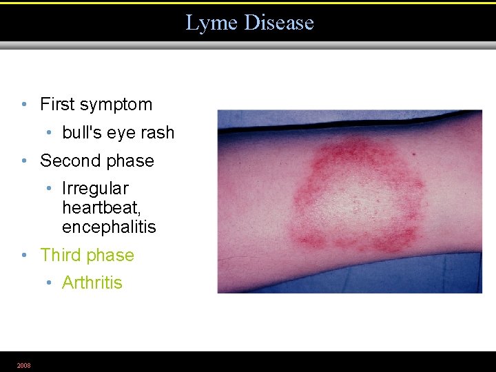 Lyme Disease • First symptom • bull's eye rash • Second phase • Irregular