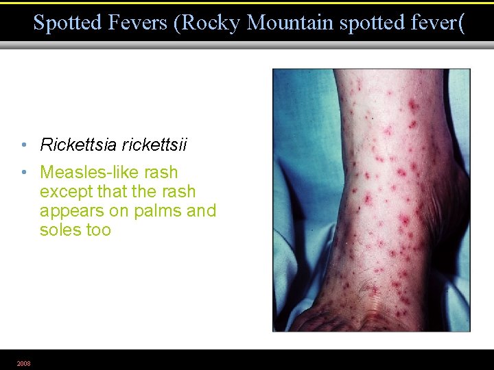 Spotted Fevers (Rocky Mountain spotted fever( • Rickettsia rickettsii • Measles-like rash except that
