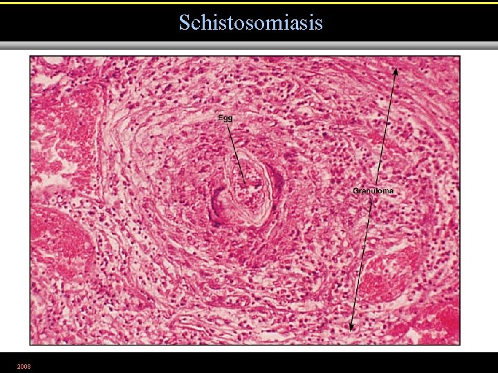 Schistosomiasis 2008 Figure 23. 28 