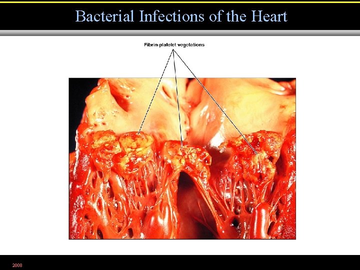 Bacterial Infections of the Heart 2008 Fgirue 23. 4 