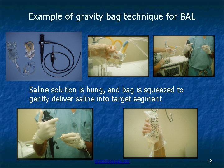 Example of gravity bag technique for BAL Saline solution is hung, and bag is