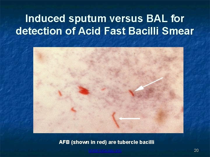 Induced sputum versus BAL for detection of Acid Fast Bacilli Smear AFB (shown in