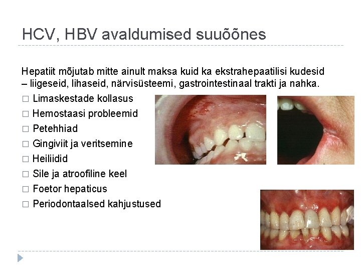 HCV, HBV avaldumised suuõõnes Hepatiit mõjutab mitte ainult maksa kuid ka ekstrahepaatilisi kudesid –