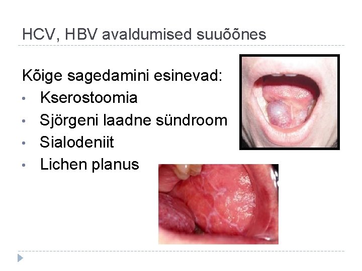 HCV, HBV avaldumised suuõõnes Kõige sagedamini esinevad: • Kserostoomia • Sjörgeni laadne sündroom •