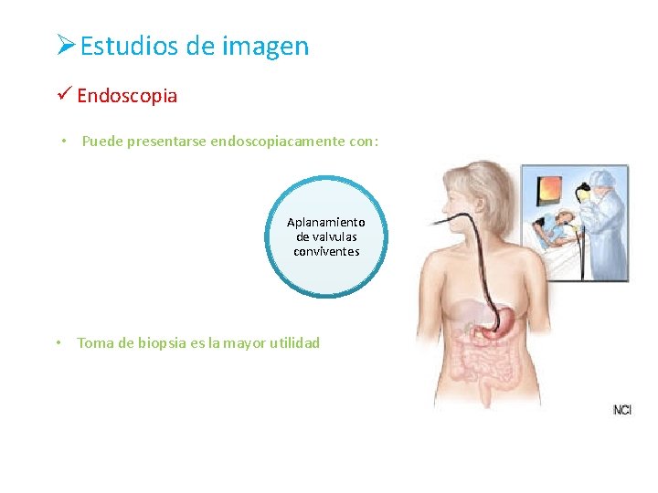 ØEstudios de imagen ü Endoscopia • Puede presentarse endoscopiacamente con: Aplanamiento de valvulas conviventes