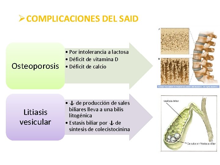 ØCOMPLICACIONES DEL SAID Osteoporosis Litiasis vesicular • Por intolerancia a lactosa • Déficit de