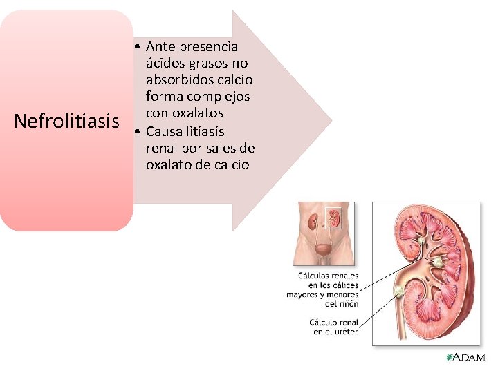 Nefrolitiasis • Ante presencia ácidos grasos no absorbidos calcio forma complejos con oxalatos •