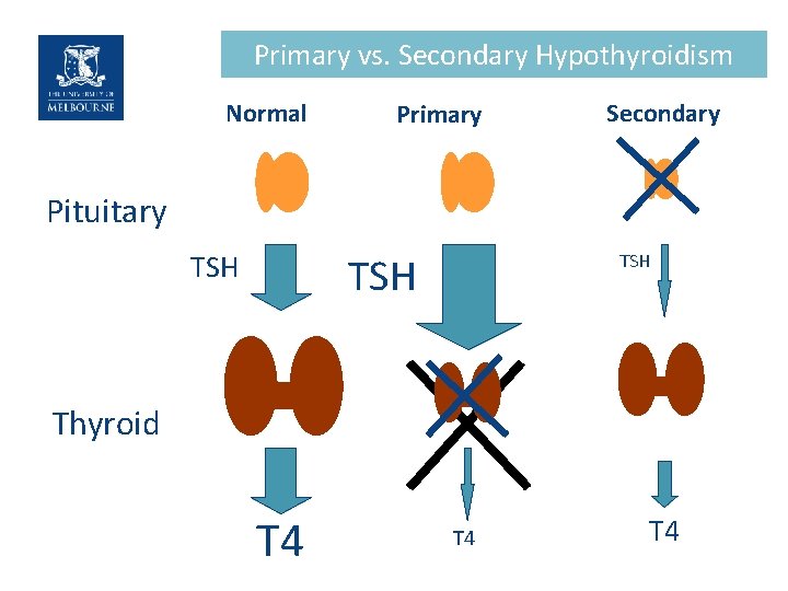 Primary vs. Secondary Hypothyroidism Normal Primary Secondary Pituitary TSH TSH Thyroid T 4 T