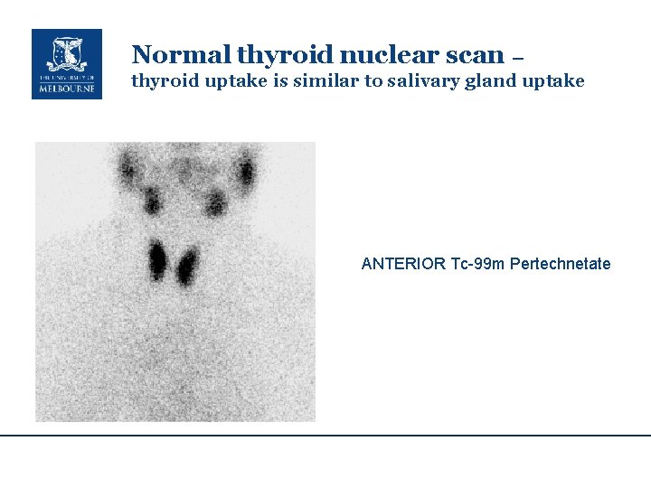 Normal thyroid nuclear scan – thyroid uptake is similar to salivary gland uptake ANTERIOR