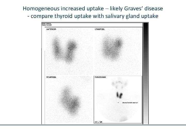 Homogeneous increased uptake – likely Graves’ disease - compare thyroid uptake with salivary gland