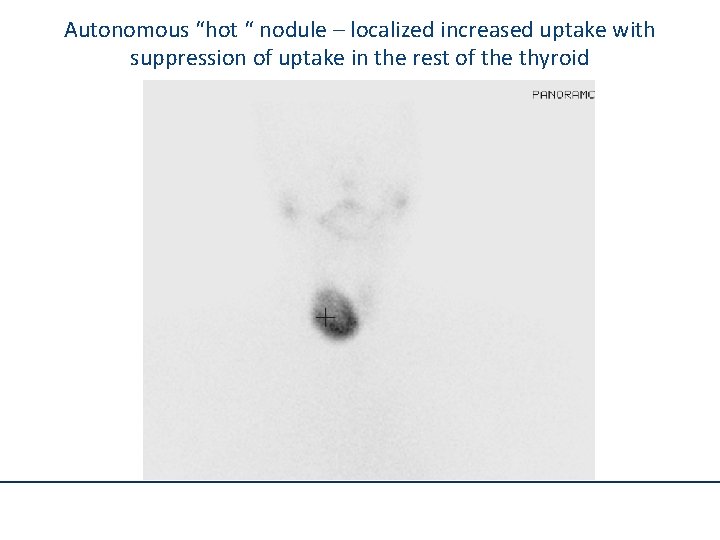 Autonomous “hot “ nodule – localized increased uptake with suppression of uptake in the