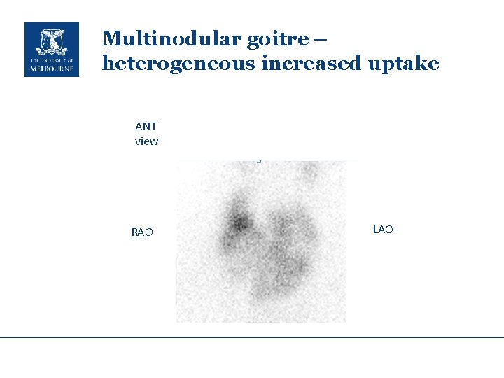 Multinodular goitre – heterogeneous increased uptake ANT view RAO LAO 