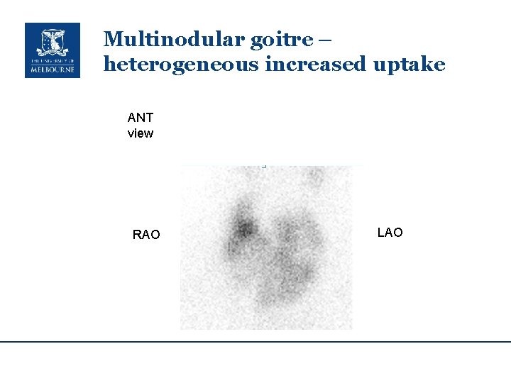 Multinodular goitre – heterogeneous increased uptake ANT view RAO LAO 