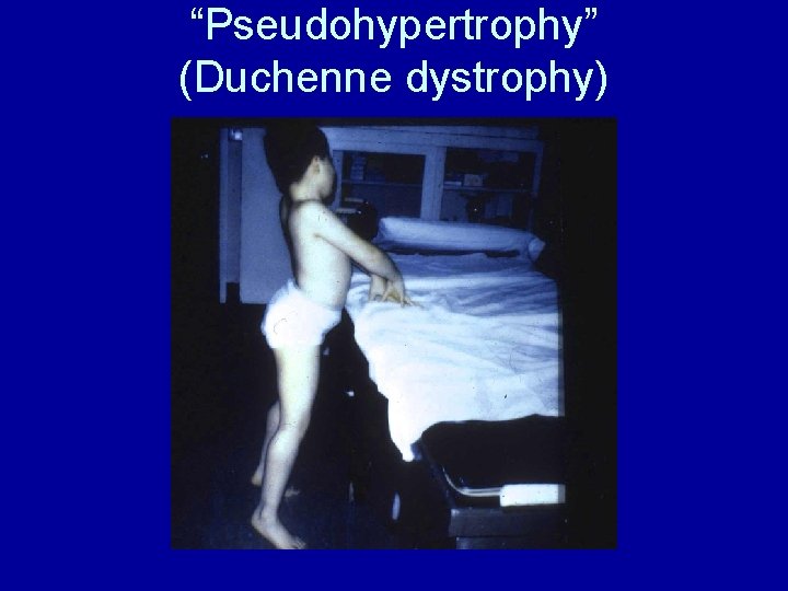 “Pseudohypertrophy” (Duchenne dystrophy) 