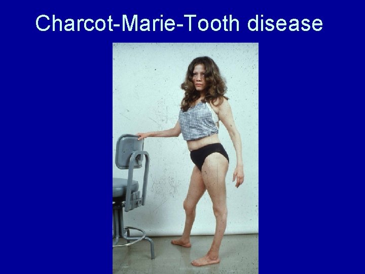 Charcot-Marie-Tooth disease 