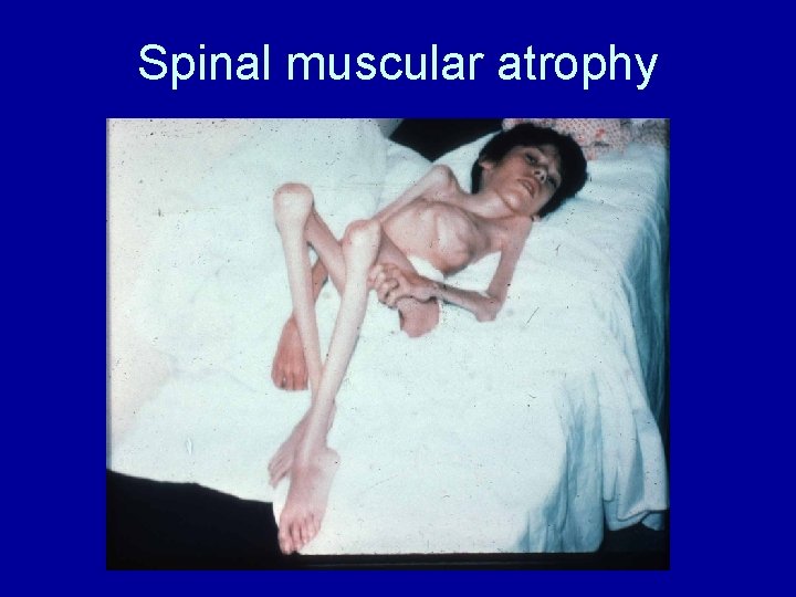 Spinal muscular atrophy 