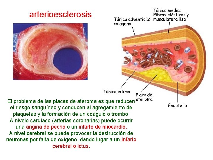 arterioesclerosis El problema de las placas de ateroma es que reducen el riesgo sanguíneo