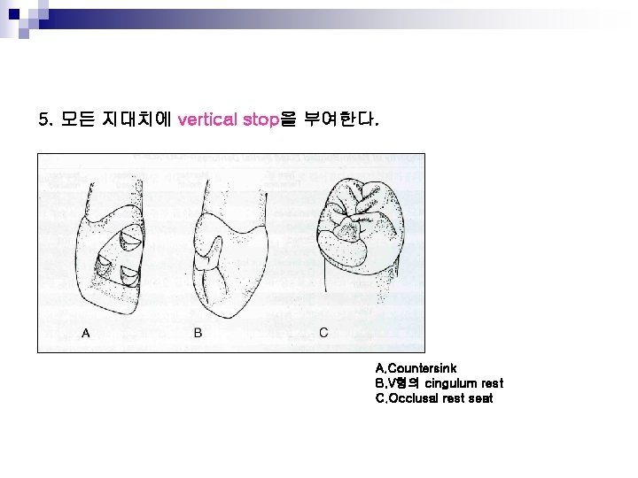 5. 모든 지대치에 vertical stop을 부여한다. A. Countersink B. V형의 cingulum rest C. Occlusal