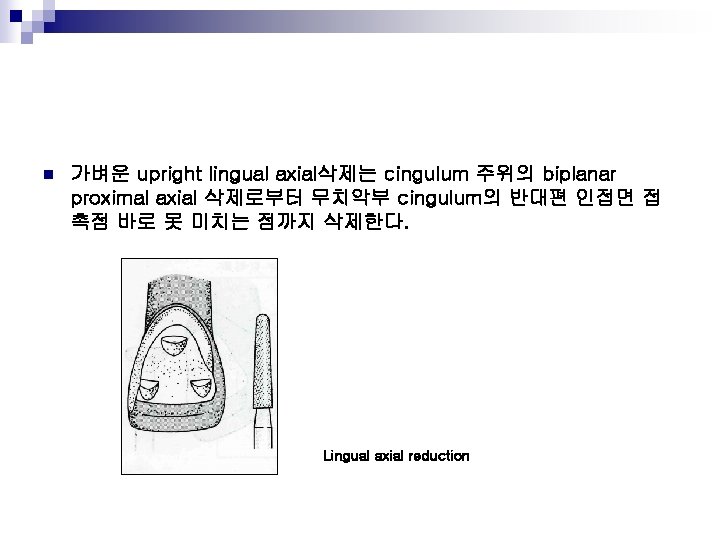 n 가벼운 upright lingual axial삭제는 cingulum 주위의 biplanar proximal axial 삭제로부터 무치악부 cingulum의 반대편
