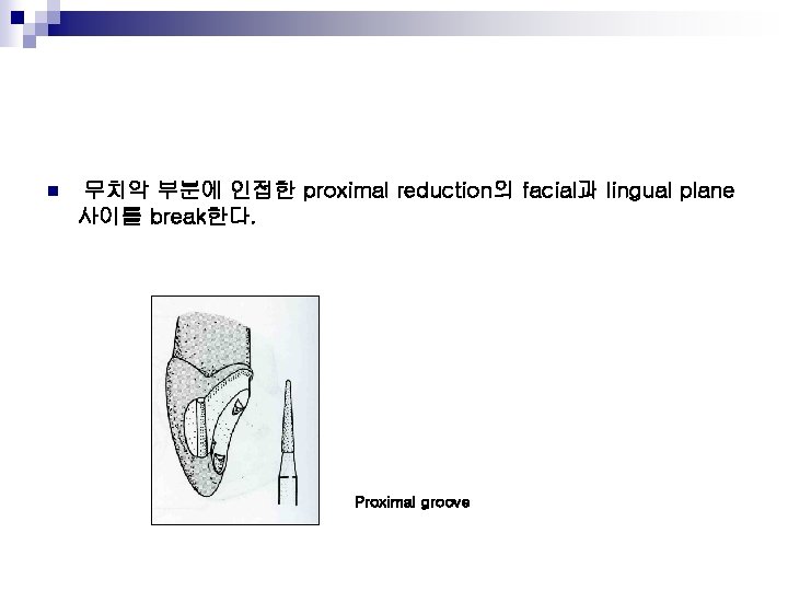 n 무치악 부분에 인접한 proximal reduction의 facial과 lingual plane 사이를 break한다. Proximal groove 