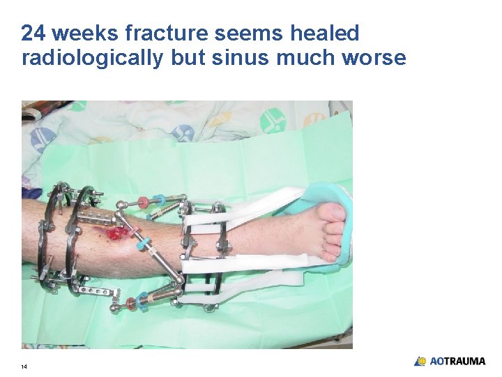 24 weeks fracture seems healed radiologically but sinus much worse 14 