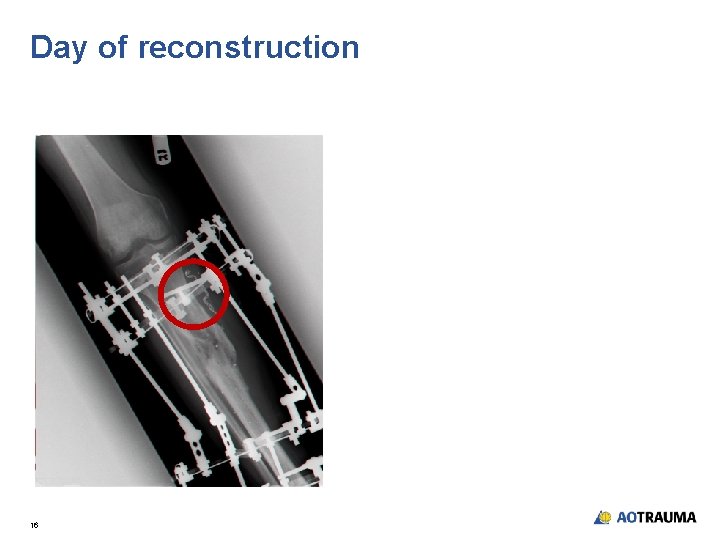 Day of reconstruction 16 