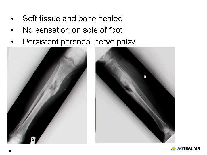  • • • 21 Soft tissue and bone healed No sensation on sole