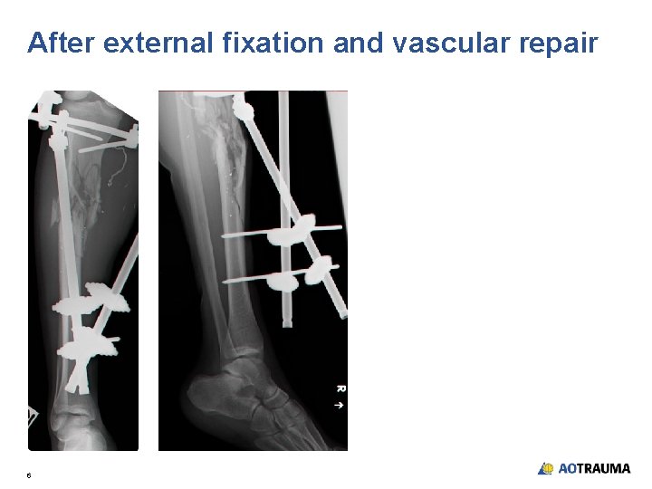 After external fixation and vascular repair 6 