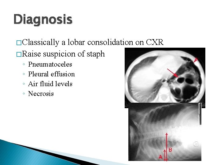 Diagnosis � Classically a lobar consolidation on CXR � Raise suspicion of staph ◦