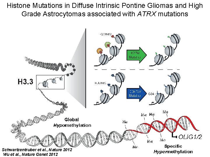 Histone Mutations in Diffuse Intrinsic Pontine Gliomas and High Grade Astrocytomas associated with ATRX