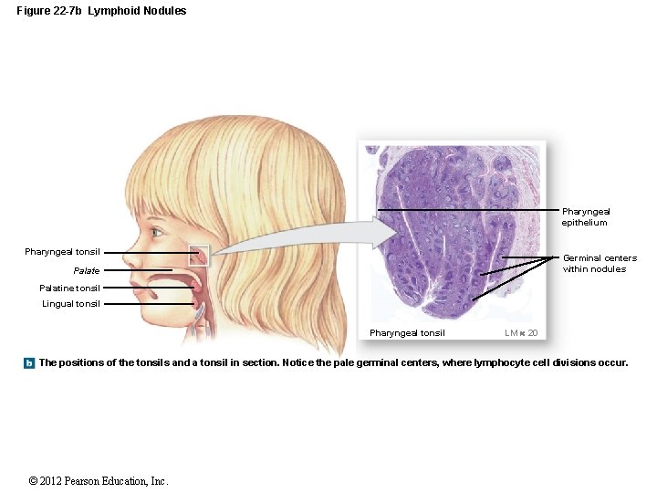 Figure 22 -7 b Lymphoid Nodules Pharyngeal epithelium Pharyngeal tonsil Germinal centers within nodules
