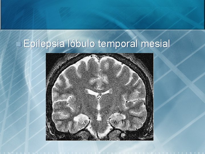 n Epilepsia lóbulo temporal mesial 