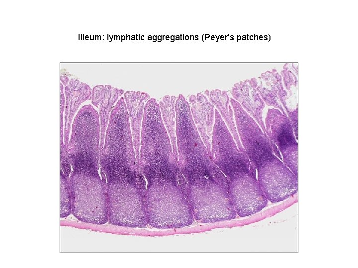 Ilieum: lymphatic aggregations (Peyer’s patches) 