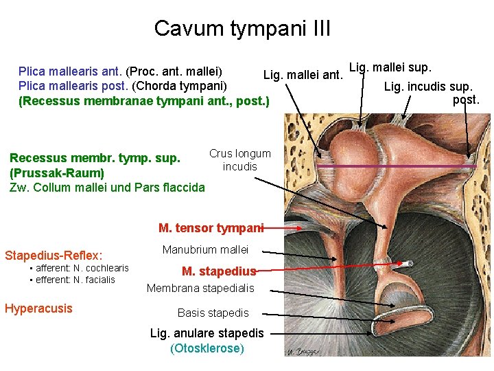 Cavum tympani III Lig. mallei sup. Plica mallearis ant. (Proc. ant. mallei) Lig. mallei