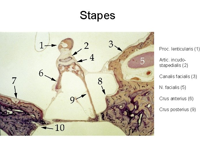 Stapes Proc. lenticularis (1) Artic. incudostapedialis (2) Canalis facialis (3) N. facialis (5) Crus