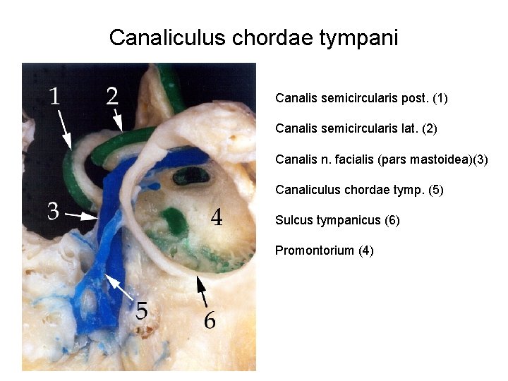 Canaliculus chordae tympani Canalis semicircularis post. (1) Canalis semicircularis lat. (2) Canalis n. facialis