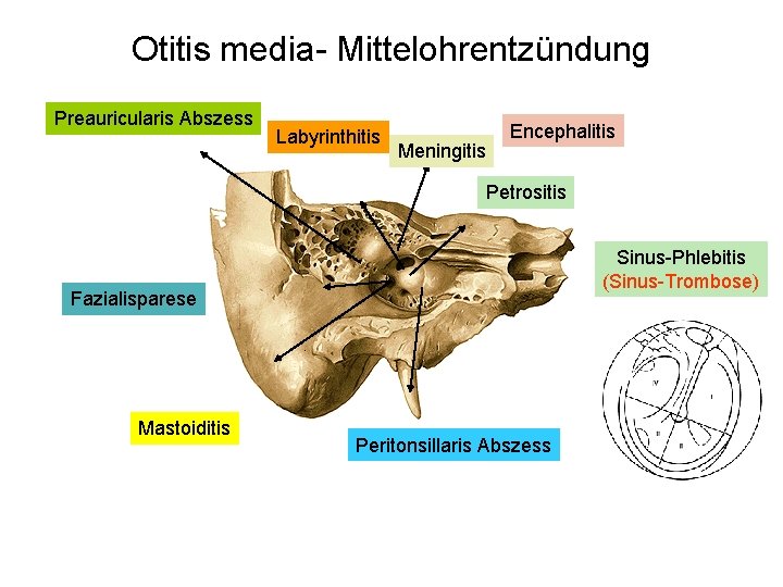Otitis media- Mittelohrentzündung Preauricularis Abszess Labyrinthitis Meningitis Encephalitis Petrositis Sinus-Phlebitis (Sinus-Trombose) Fazialisparese Mastoiditis Peritonsillaris