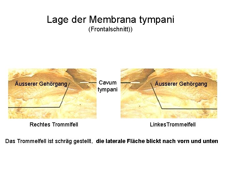 Lage der Membrana tympani (Frontalschnitt)) Äusserer Gehörgang Rechtes Trommlfell Cavum tympani Äusserer Gehörgang Linkes.