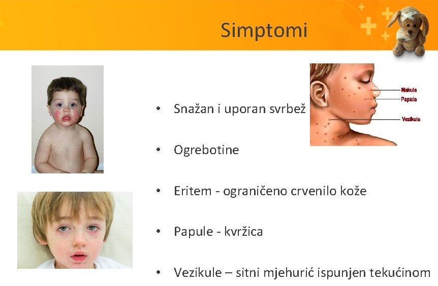 Simptomi • Snažan i uporan svrbež • Ogrebotine • Eritem - ograničeno crvenilo kože