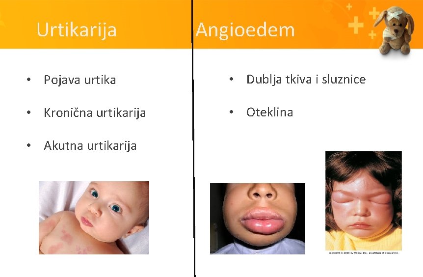 Urtikarija Angioedem • Pojava urtika • Dublja tkiva i sluznice • Kronična urtikarija •