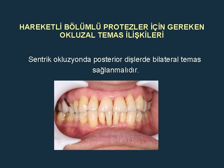 HAREKETLİ BÖLÜMLÜ PROTEZLER İÇİN GEREKEN OKLUZAL TEMAS İLİŞKİLERİ Sentrik okluzyonda posterior dişlerde bilateral temas