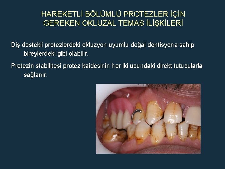 HAREKETLİ BÖLÜMLÜ PROTEZLER İÇİN GEREKEN OKLUZAL TEMAS İLİŞKİLERİ Diş destekli protezlerdeki okluzyon uyumlu doğal