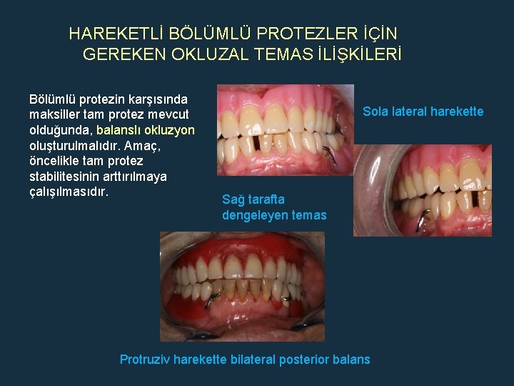 HAREKETLİ BÖLÜMLÜ PROTEZLER İÇİN GEREKEN OKLUZAL TEMAS İLİŞKİLERİ Bölümlü protezin karşısında maksiller tam protez