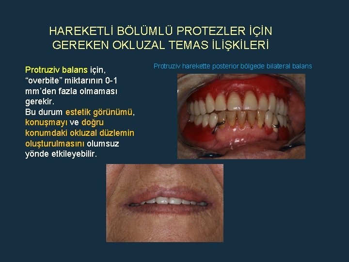 HAREKETLİ BÖLÜMLÜ PROTEZLER İÇİN GEREKEN OKLUZAL TEMAS İLİŞKİLERİ Protruziv balans için, “overbite” miktarının 0