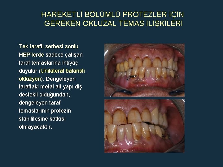 HAREKETLİ BÖLÜMLÜ PROTEZLER İÇİN GEREKEN OKLUZAL TEMAS İLİŞKİLERİ Tek taraflı serbest sonlu HBP’lerde sadece