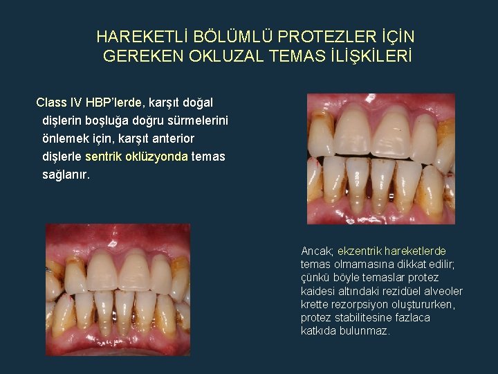 HAREKETLİ BÖLÜMLÜ PROTEZLER İÇİN GEREKEN OKLUZAL TEMAS İLİŞKİLERİ Class IV HBP’lerde, karşıt doğal dişlerin