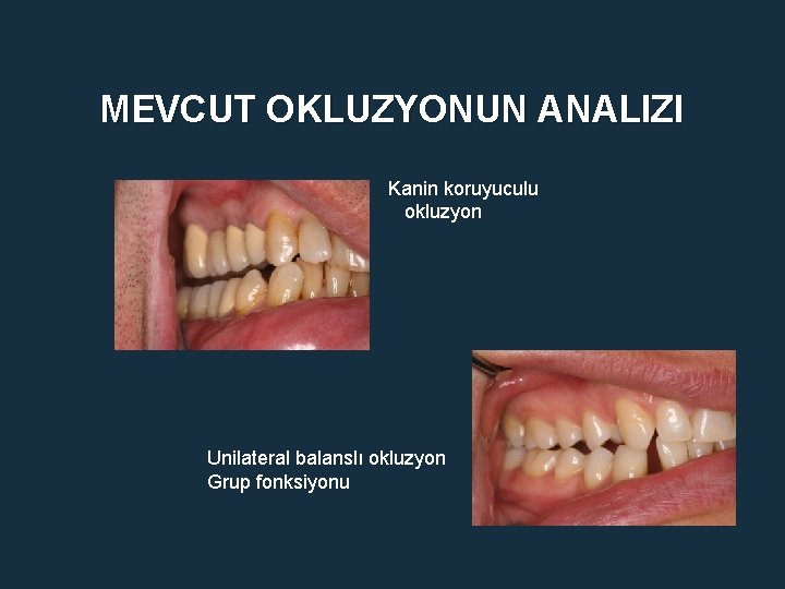 MEVCUT OKLUZYONUN ANALIZI Kanin koruyuculu okluzyon Unilateral balanslı okluzyon Grup fonksiyonu 