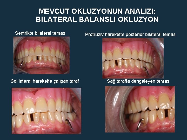 MEVCUT OKLUZYONUN ANALIZI: BILATERAL BALANSLI OKLUZYON Sentrikte bilateral temas Sol lateral harekette çalışan taraf