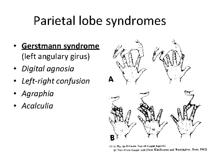 Parietal lobe syndromes • Gerstmann syndrome (left angulary girus) • Digital agnosia • Left-right