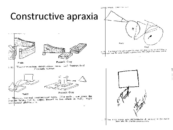 Constructive apraxia 